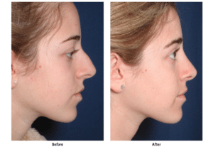 Before and after image of a young woman who has received rhinoplasty surgery at Dr. Ronald Schuster’s office in Baltimore.